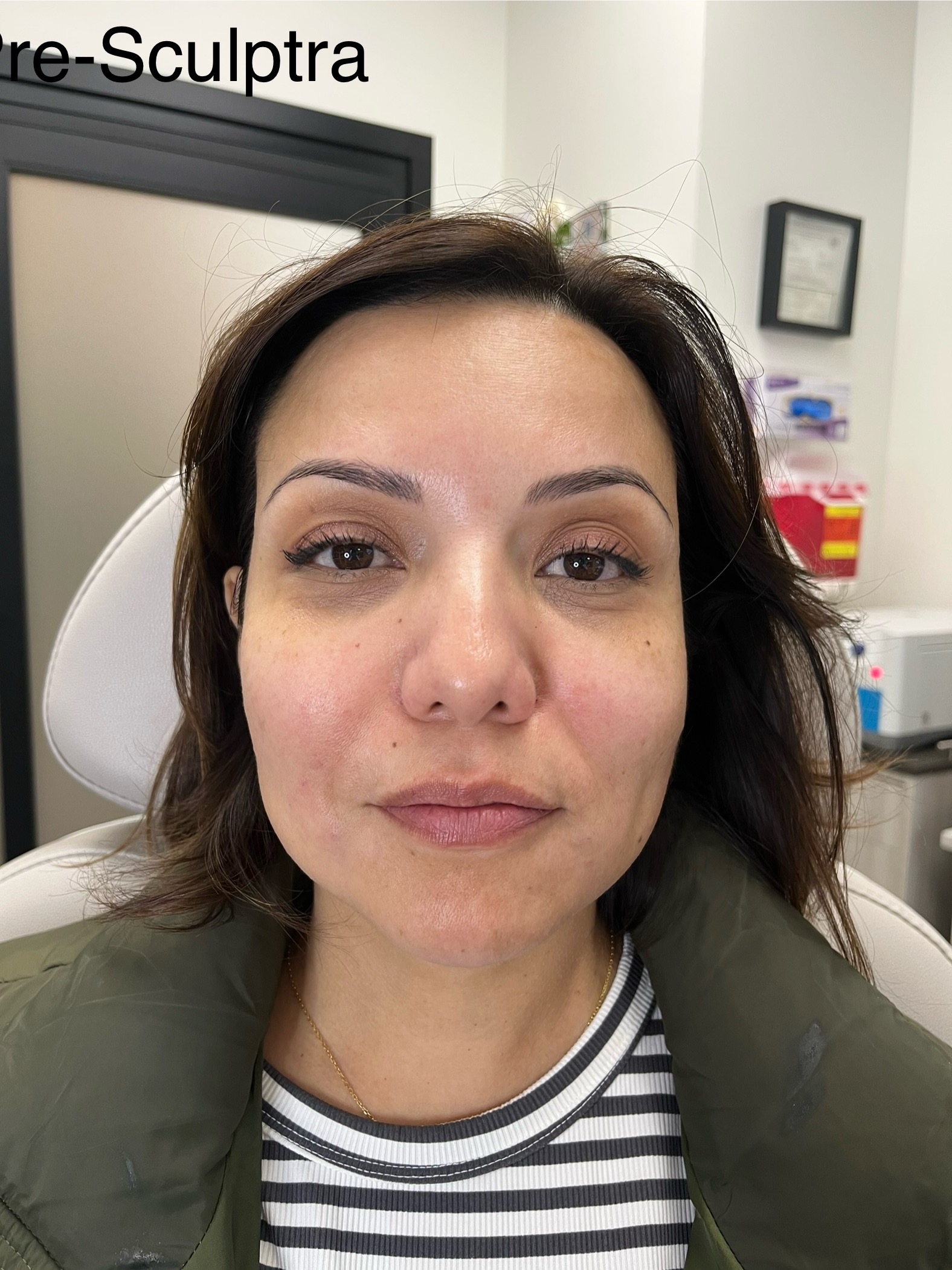 Inner Beauty and Skin Clovis CA Botox, Facials & Skin Treatments Pre-Sculptra 1